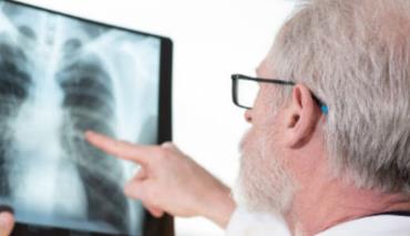 Компания MSD объявила о прекращении исследований терапии рака легкого